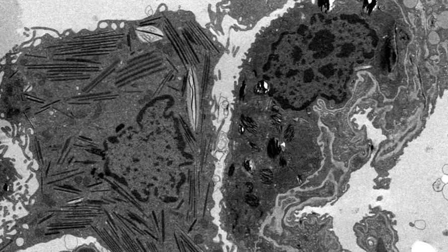 Black and white cell imaging showing lipid accumulation in lung macrophages.