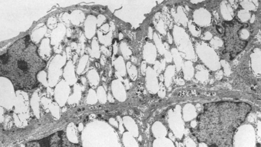 Black and white cell imaging of an atherosclerotic lesion with macrophage foam cells.