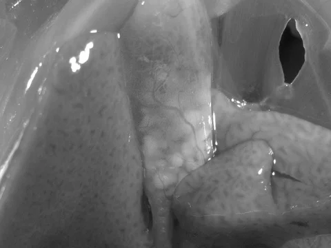 Black and white image of gallstones.