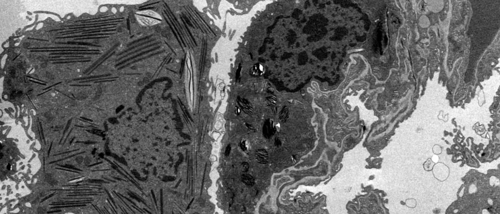 Black and white cell imaging showing lipid accumulation in lung macrophages.