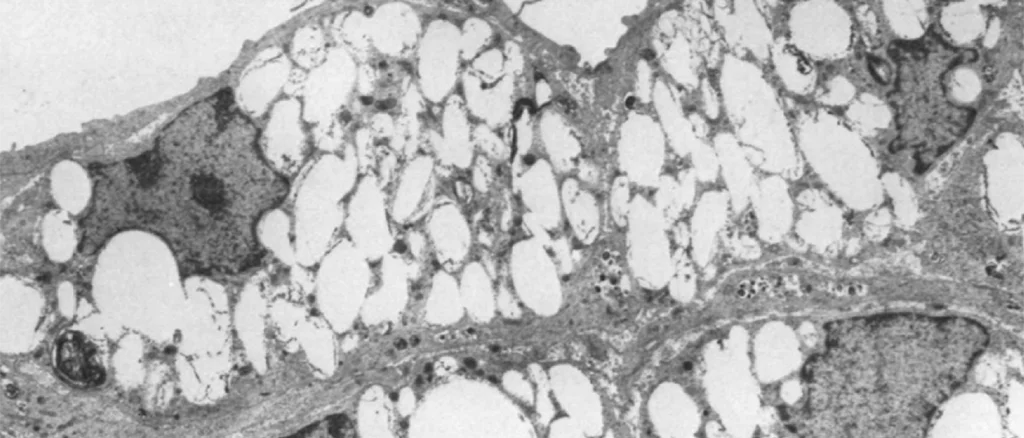 Black and white cell imaging of an atherosclerotic lesion with macrophage foam cells.